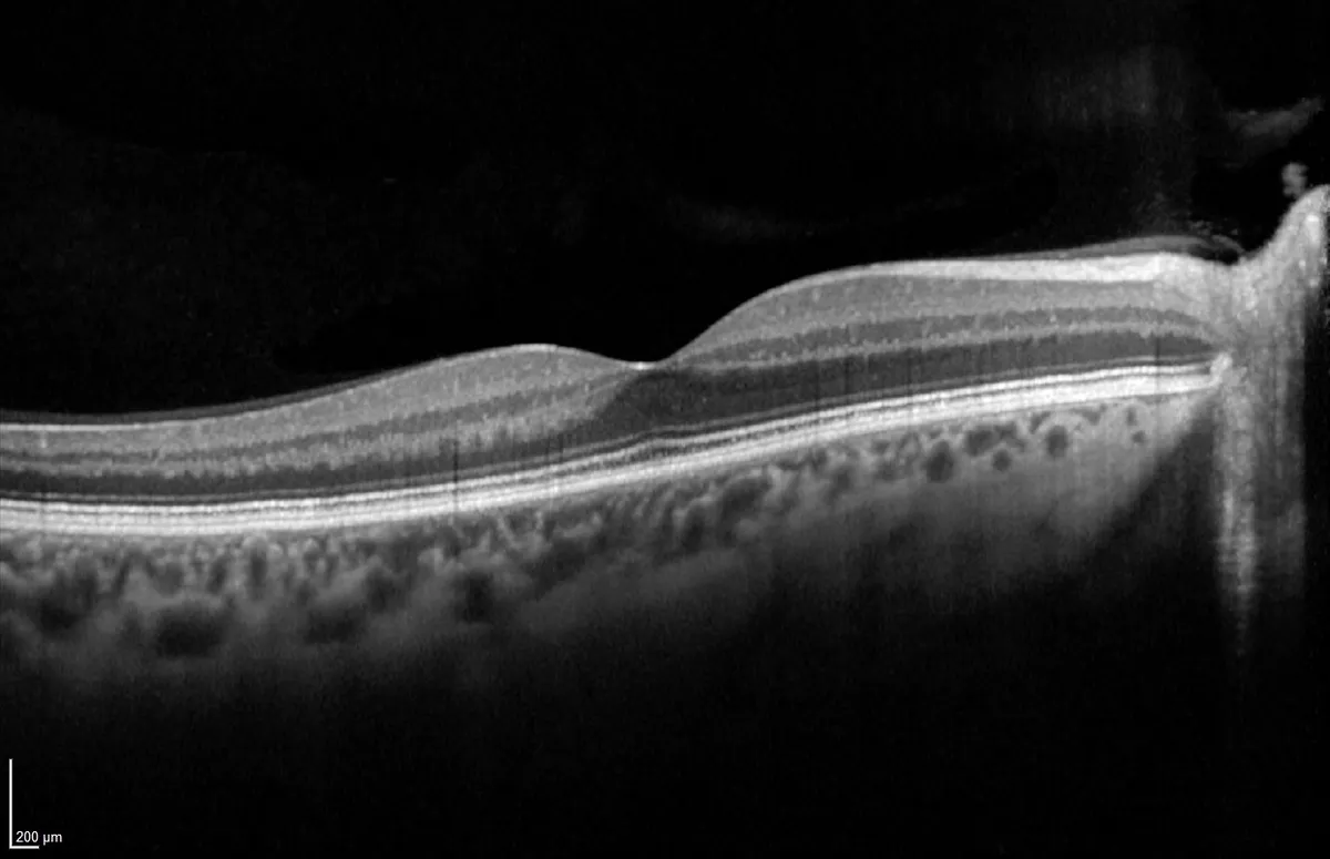 OCT Optische Kohärenztomographie